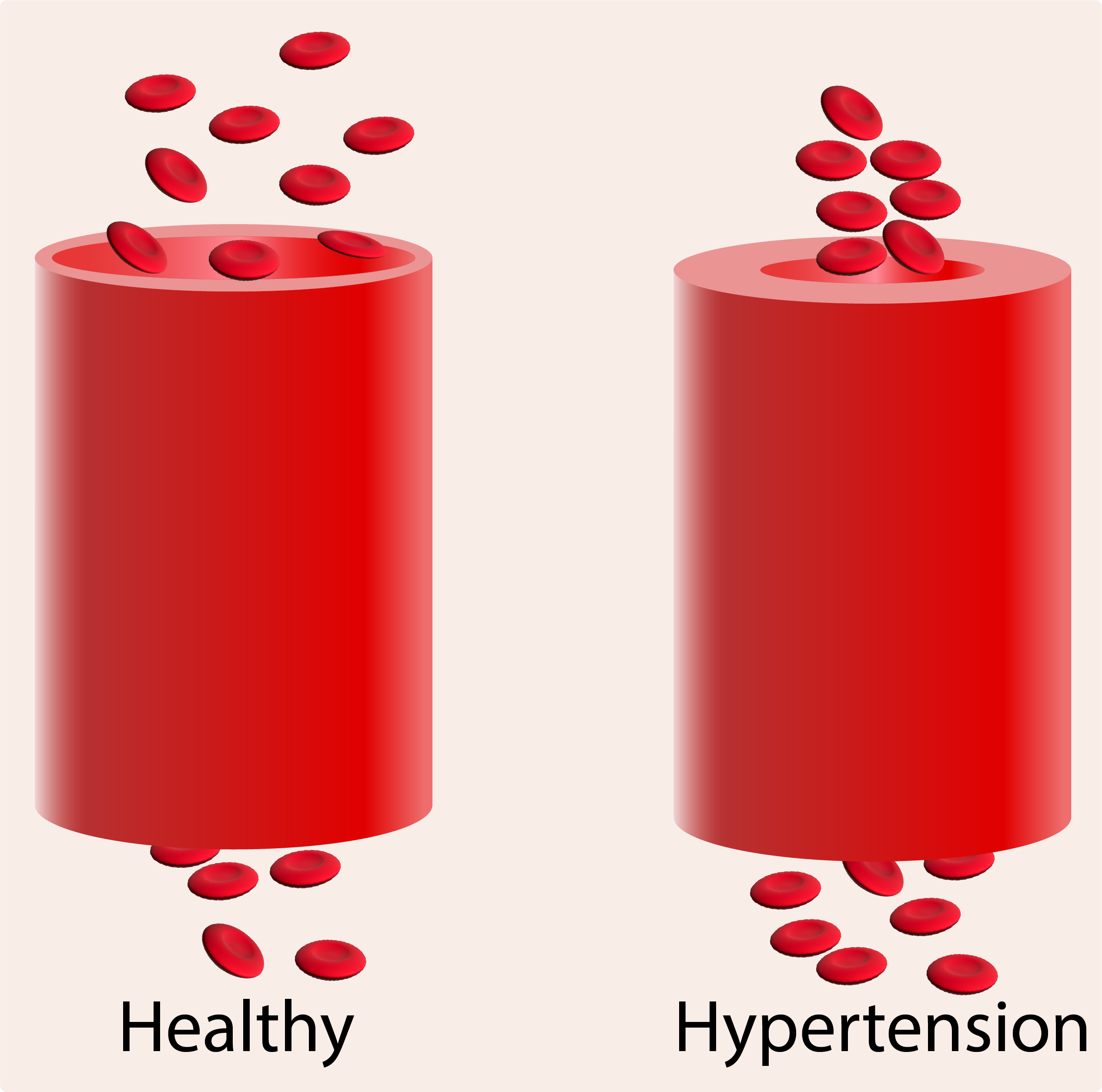 Hypertension
